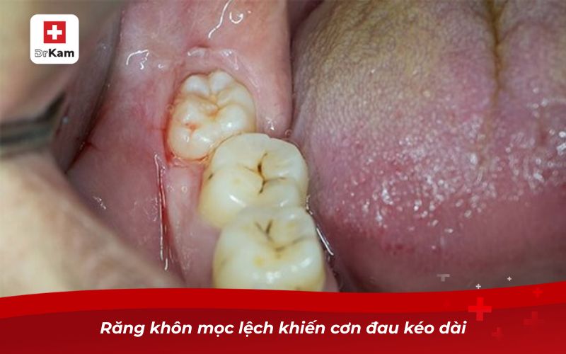 Răng không sâu nhưng bị nhức – Nguyên nhân và cách khắc phục 9 Răng khôn mọc lệch khiến cơn đau kéo dài