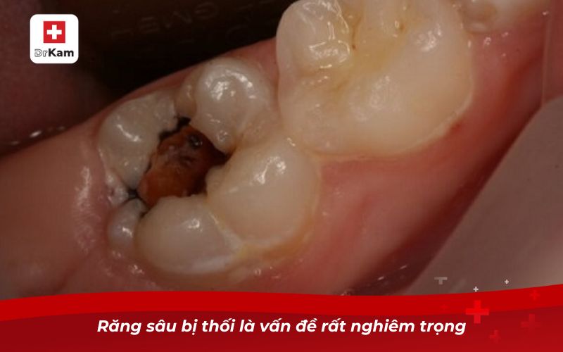 Răng Sâu Bị Thối - Nguyên Nhân, Hậu Quả Và Cách Xử Lý 9 Răng sâu bị thối là vấn đề rất nghiêm trọng