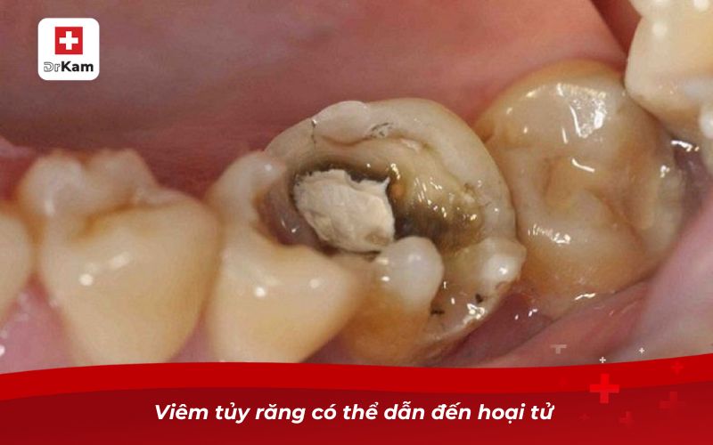 Răng Sâu Bị Thối - Nguyên Nhân, Hậu Quả Và Cách Xử Lý 10 Viêm tủy răng có thể dẫn đến hoại tử