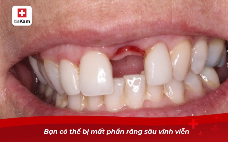 Răng Sâu Bị Thối - Nguyên Nhân, Hậu Quả Và Cách Xử Lý 12 Bạn có thể bị mất phần răng sâu vĩnh viễn