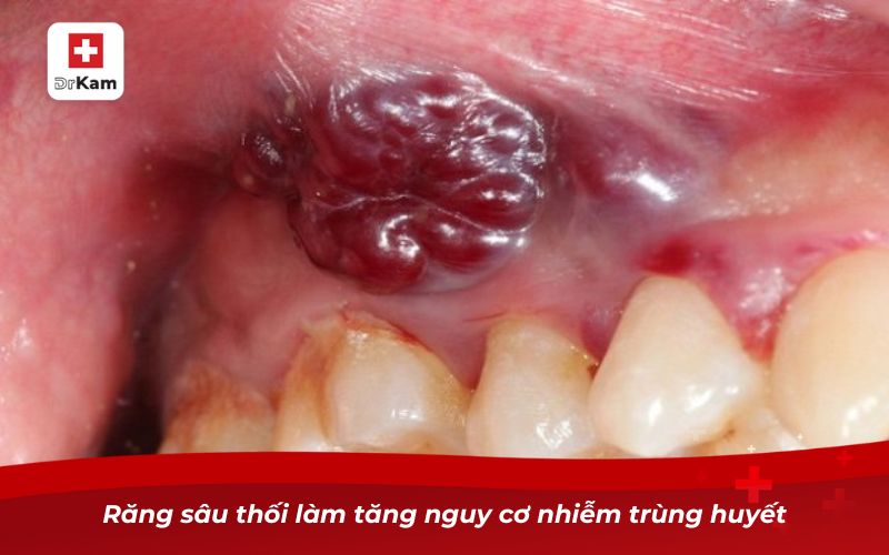 Răng Sâu Bị Thối - Nguyên Nhân, Hậu Quả Và Cách Xử Lý 13 Răng sâu thối làm tăng nguy cơ nhiễm trùng huyết
