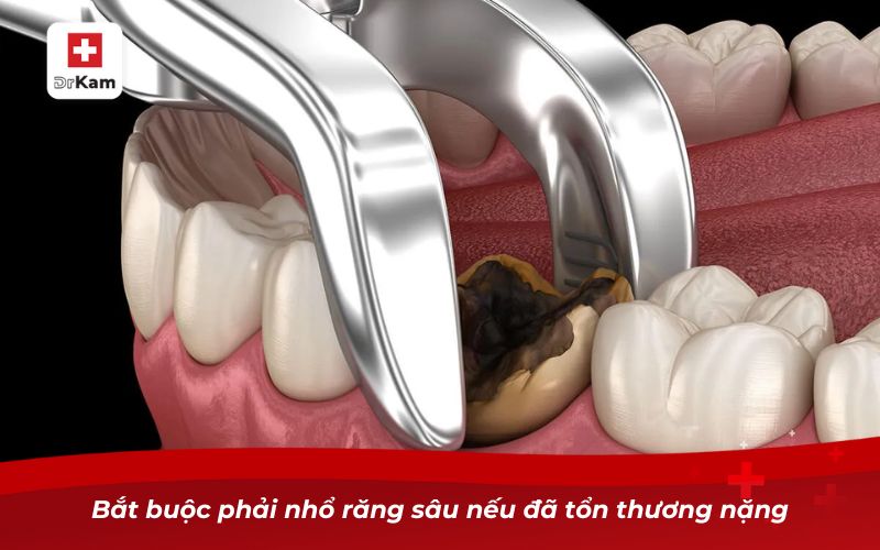 Răng Sâu Bị Thối - Nguyên Nhân, Hậu Quả Và Cách Xử Lý 14 Bắt buộc phải nhổ răng sâu nếu đã tổn thương nặng