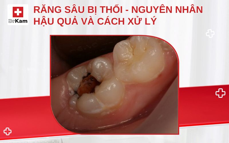 rang sau bi thoi thumbnail