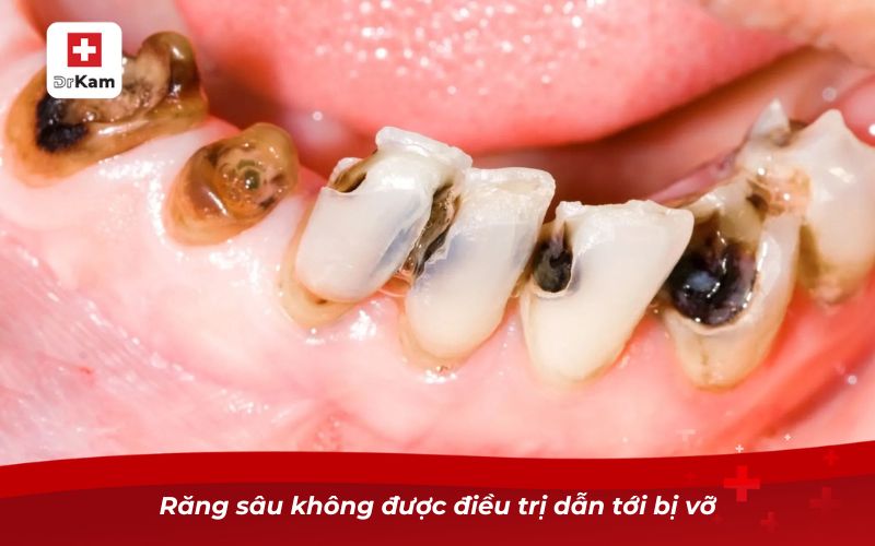 Răng sâu bị vỡ hết - Nguyên nhân và cách xử lý 6 Răng sâu không được điều trị dẫn tới bị vỡ