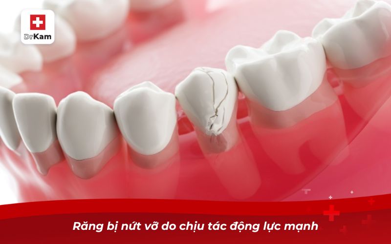 Răng sâu bị vỡ hết - Nguyên nhân và cách xử lý 7 Răng bị nứt vỡ do chịu tác động lực mạnh