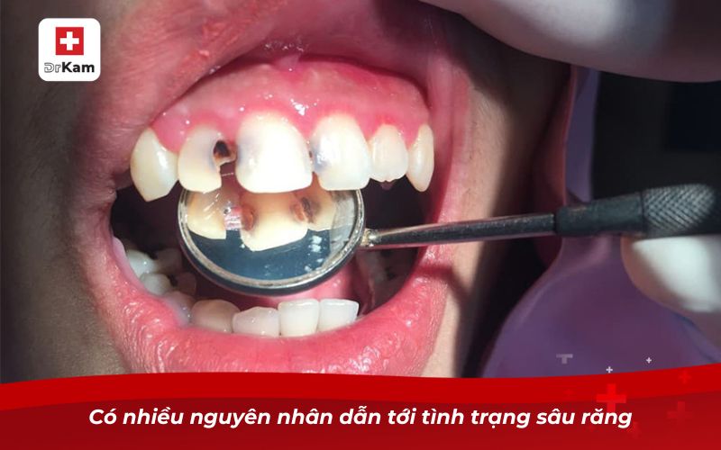 Răng sâu không trám có sao không? Nguy cơ và giải pháp xử lý 7 Có nhiều nguyên nhân dẫn tới tình trạng sâu răng