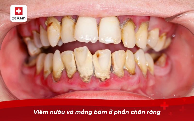 Răng sâu không trám có sao không? Nguy cơ và giải pháp xử lý 8 Viêm nướu và mảng bám ở phần chân răng