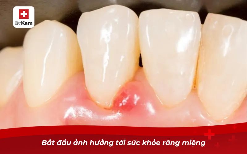 Răng sâu không trám có sao không? Nguy cơ và giải pháp xử lý 9 Bắt đầu ảnh hưởng tới sức khỏe răng miệng