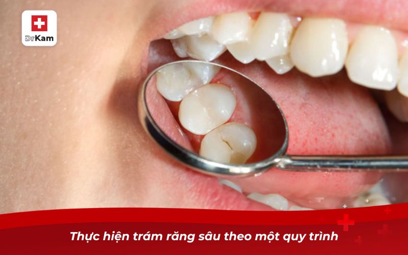 Răng sâu không trám có sao không? Nguy cơ và giải pháp xử lý 10 Thực hiện trám răng sâu theo một quy trình