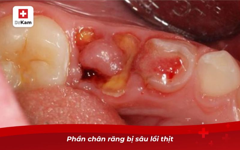 Phần chân răng bị sâu lồi thịt