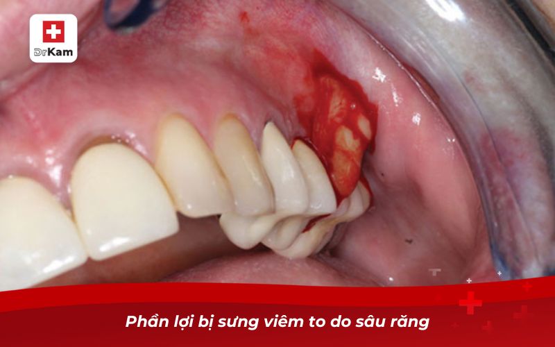 Phần lợi bị sưng viêm to do sâu răng