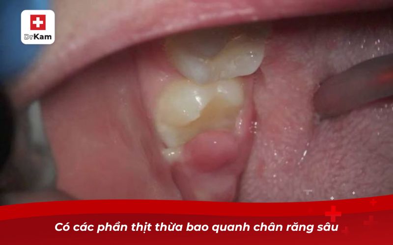 Có các phần thịt thừa bao quanh chân răng sâu