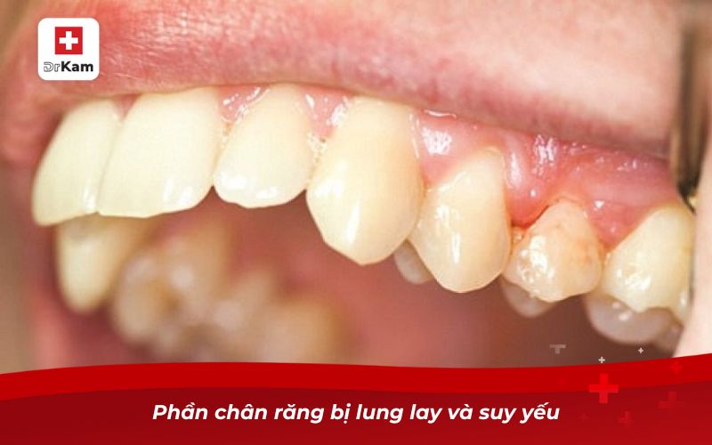 Phần chân răng bị lung lay và suy yếu