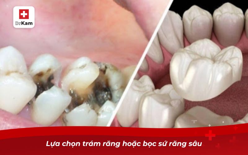 Lựa chọn trám răng hoặc bọc sứ răng sâu
