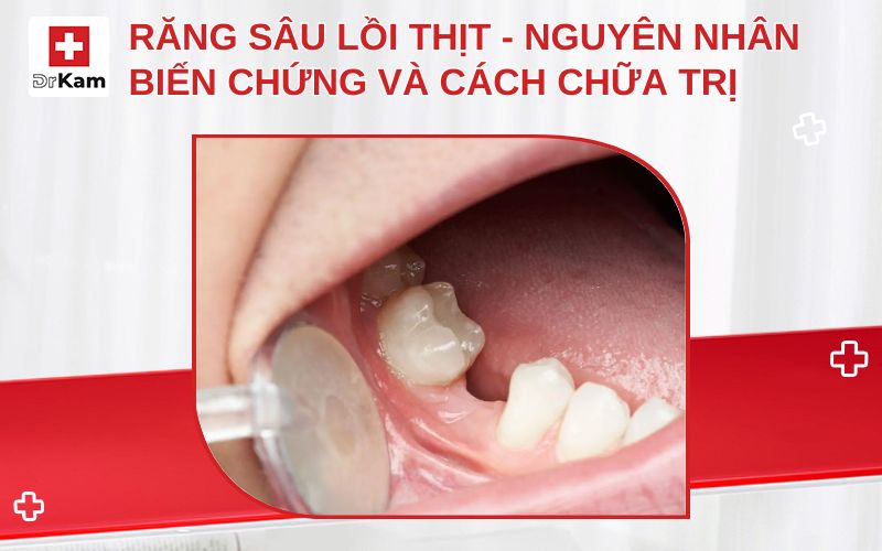rang sau loi thit thumbnail