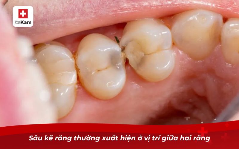 Sâu kẽ răng - Hướng dẫn nhận biết và điều trị triệt để 6 Sâu kẽ răng thường xuất hiện ở vị trí giữa hai răng