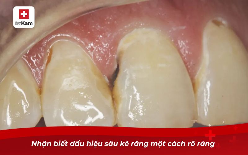 Sâu kẽ răng - Hướng dẫn nhận biết và điều trị triệt để 7 Nhận biết dấu hiệu sâu kẽ răng một cách rõ ràng