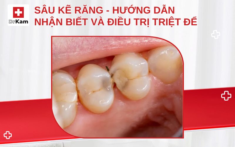 sau ke rang thumbnail