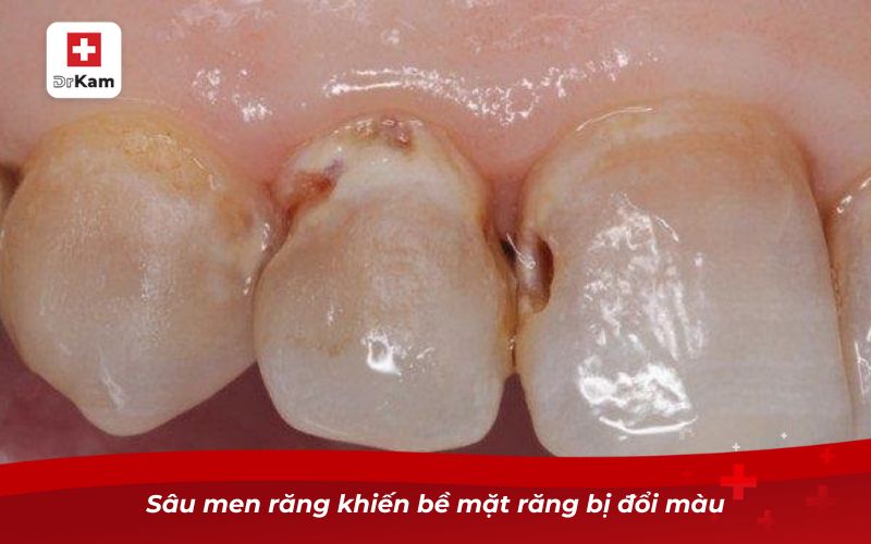 Sâu men răng khiến bề mặt răng bị đổi màu