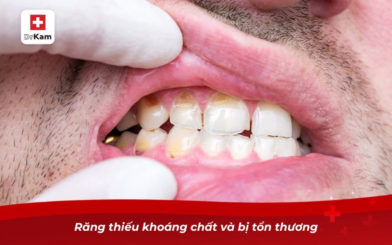 Răng thiếu khoáng chất và bị tổn thương
