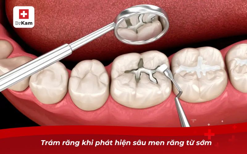 Trám răng khi phát hiện sâu men răng từ sớm