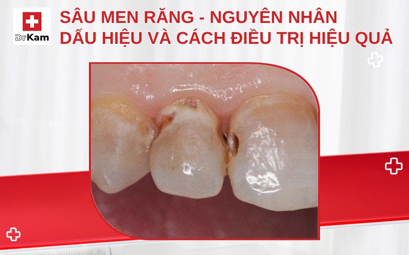 sau men rang thumbnail