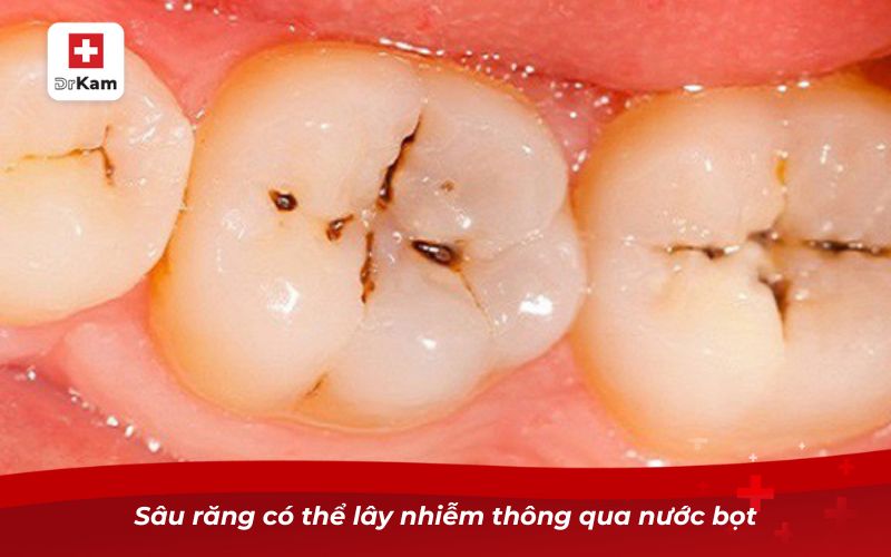 Sâu răng có thể lây nhiễm thông qua nước bọt