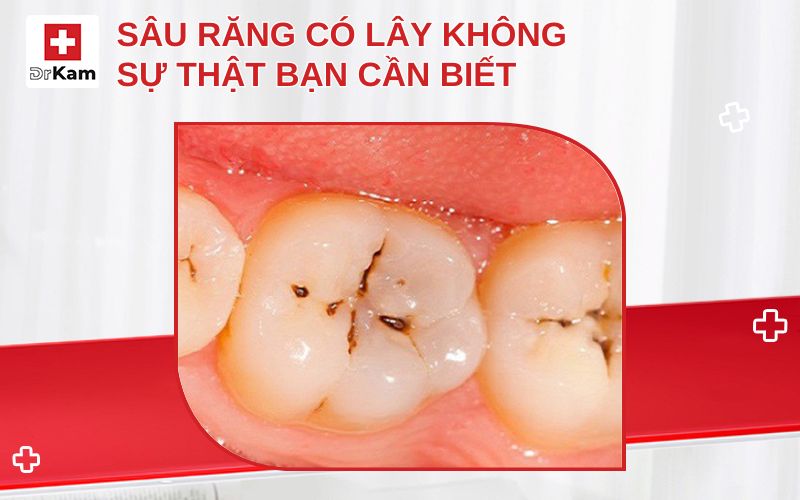sau rang co lay khong thumbnail