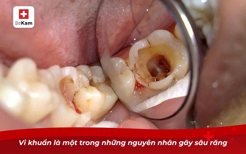 Sâu răng để lâu có sao không? Tìm hiểu ngay! 8 Vi khuẩn là một trong những nguyên nhân gây sâu răng