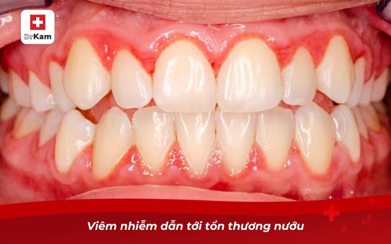 Sâu răng để lâu có sao không? Tìm hiểu ngay! 10 Viêm nhiễm dẫn tới tổn thương nướu