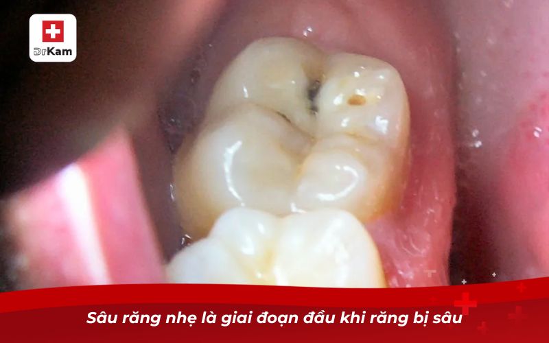 Sâu răng nhẹ là giai đoạn đầu khi răng bị sâu
