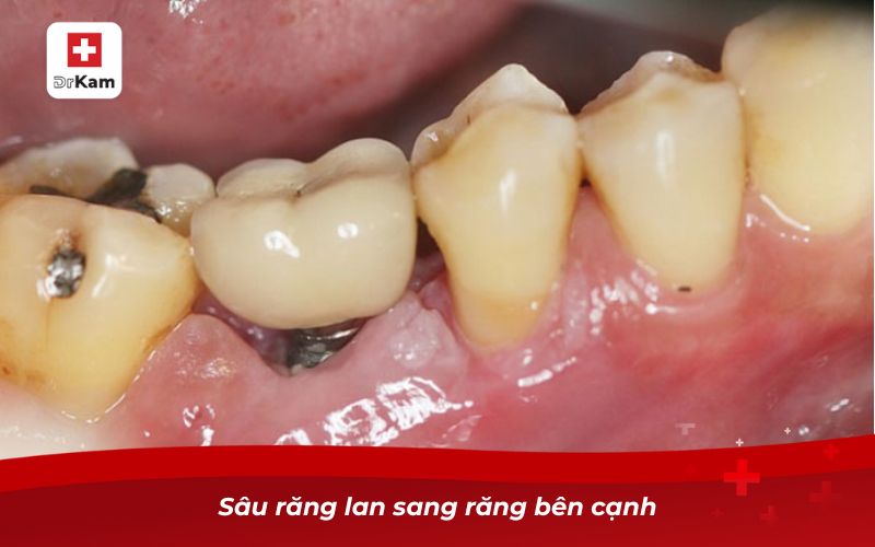 Tác hại của việc không nhổ răng sâu và cách khắc phục 8 Sâu răng lan sang răng bên cạnh