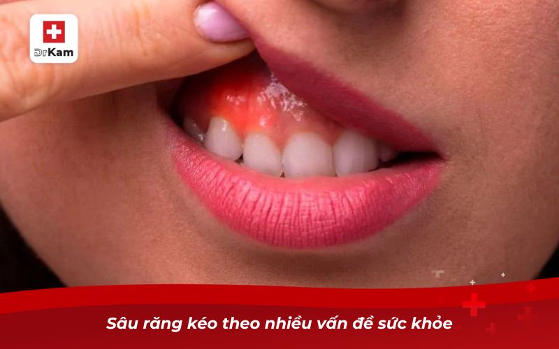 Tác hại của việc không nhổ răng sâu và cách khắc phục 9 Sâu răng kéo theo nhiều vấn đề sức khỏe