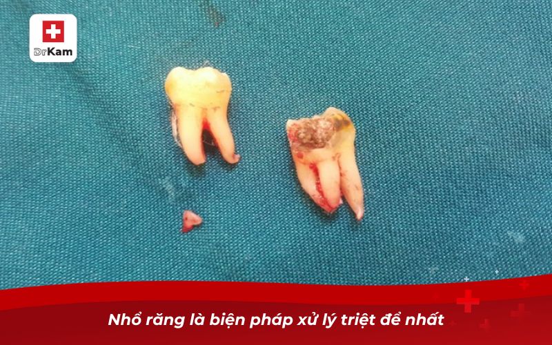 Tác hại của việc không nhổ răng sâu và cách khắc phục 10 Nhổ răng là biện pháp xử lý triệt để nhất