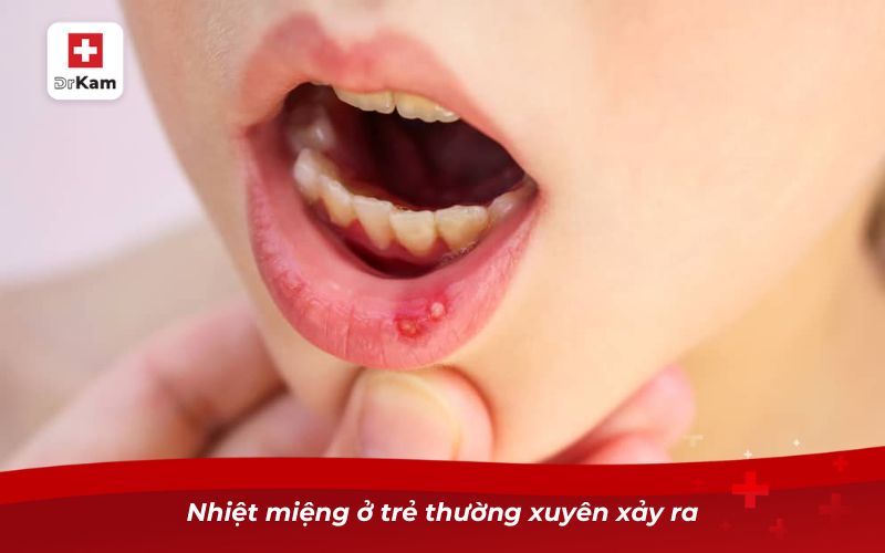Nhiệt miệng ở trẻ thường xuyên xảy ra