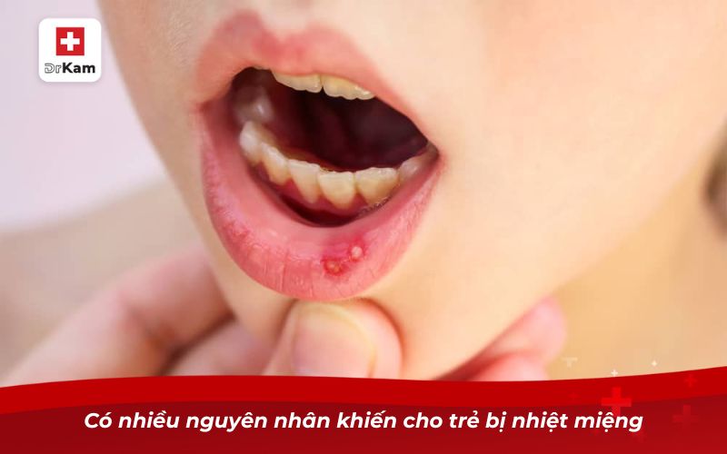 Trẻ em bị nhiệt miệng - Nguyên nhân và cách điều trị cấp tốc 7 Có nhiều nguyên nhân khiến cho trẻ bị nhiệt miệng