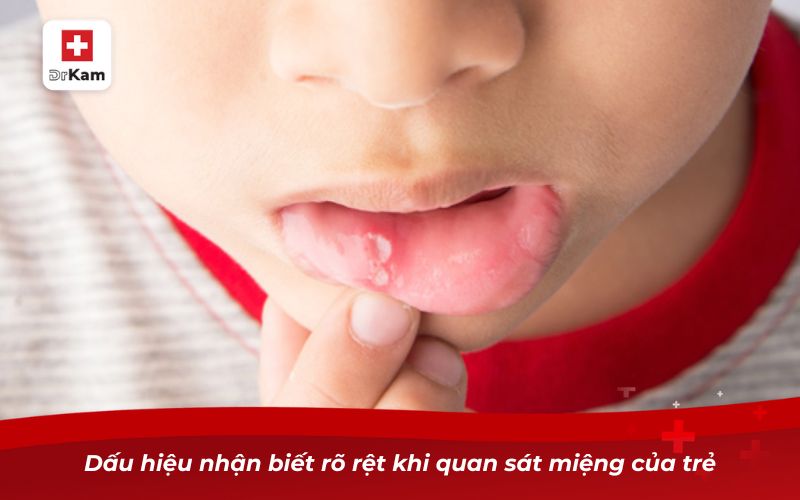 Trẻ em bị nhiệt miệng - Nguyên nhân và cách điều trị cấp tốc 8 Dấu hiệu nhận biết rõ rệt khi quan sát miệng của trẻ
