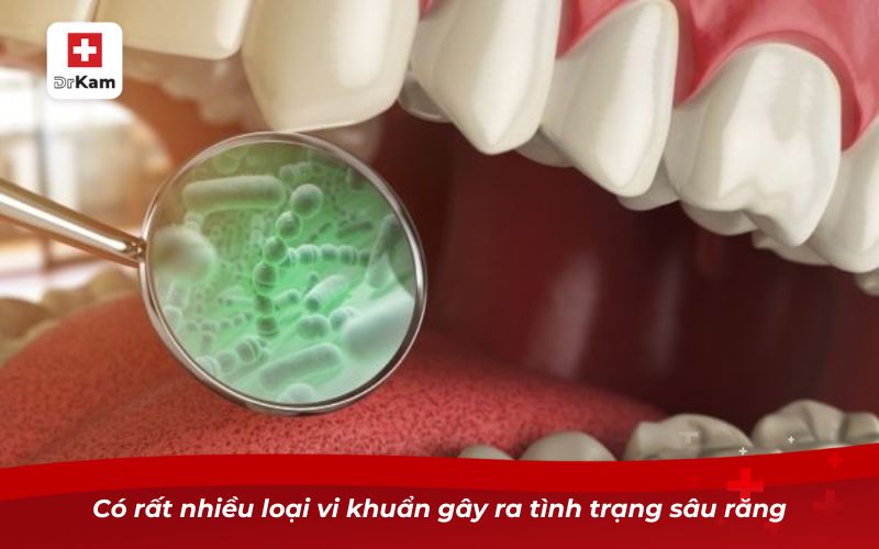 Có rất nhiều loại vi khuẩn gây ra tình trạng sâu răng