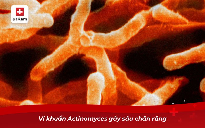 Vi khuẩn Actinomyces gây sâu chân răng