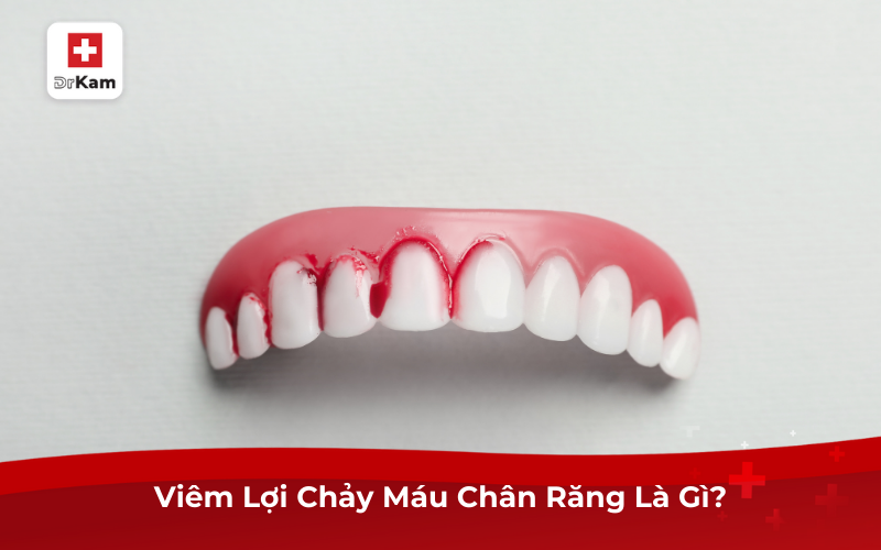 Viêm Lợi Chảy Máu Chân Răng Là Gì?