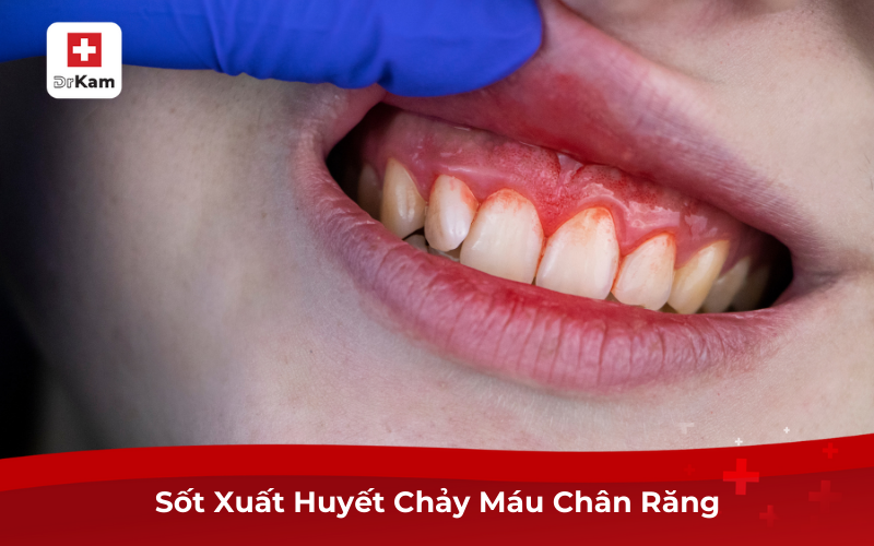 Nguyên Nhân, Cách Điều Trị Sốt Xuất Huyết Chảy Máu Chân Răng 6 Sốt Xuất Huyết Chảy Máu Chân Răng