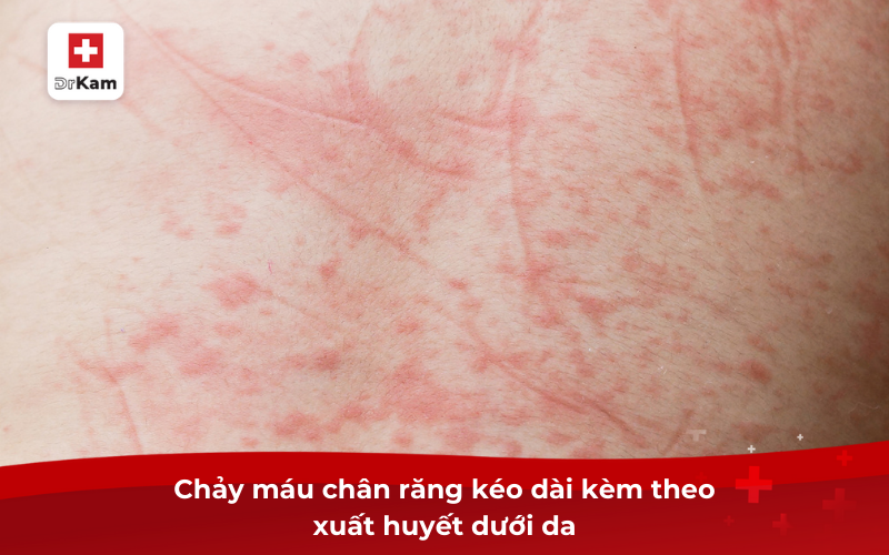 Nguyên Nhân, Cách Điều Trị Sốt Xuất Huyết Chảy Máu Chân Răng 9 Xuất Huyết Dưới Da