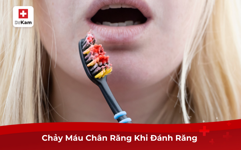 Nguyên Nhân, Cách Điều Trị Chảy Máu Chân Răng Khi Đánh Răng 6 Chảy Máu Chân Răng Khi Đánh Răng