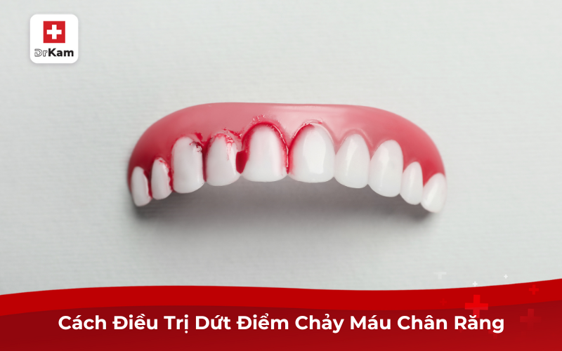 Cách Điều Trị Dứt Điểm Chảy Máu Chân Răng 7 Cách Điều Trị Dứt Điểm Chảy Máu Chân Răng