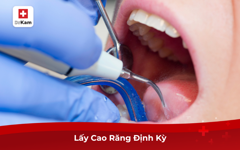 Cách Điều Trị Dứt Điểm Chảy Máu Chân Răng 8 Lấy cao răng định kỳ