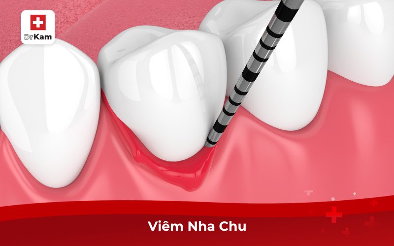 Tự Nhiên Chảy Máu Chân Răng Là Bệnh Gì? Cách Điều Trị 6 Viêm nha chu