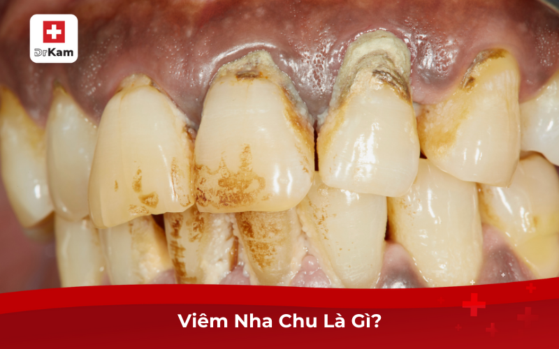 Hình Ảnh Bị Viêm Nha Chu Giúp Sớm Nhận Biết Và Điều Trị 7 Viêm Nha Chu Là Gì?