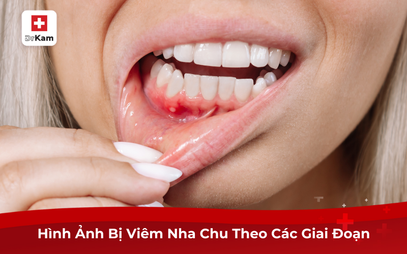 Hình Ảnh Bị Viêm Nha Chu Giúp Sớm Nhận Biết Và Điều Trị 8 Hình Ảnh Bị Viêm Nha Chu Theo Các Giai Đoạn