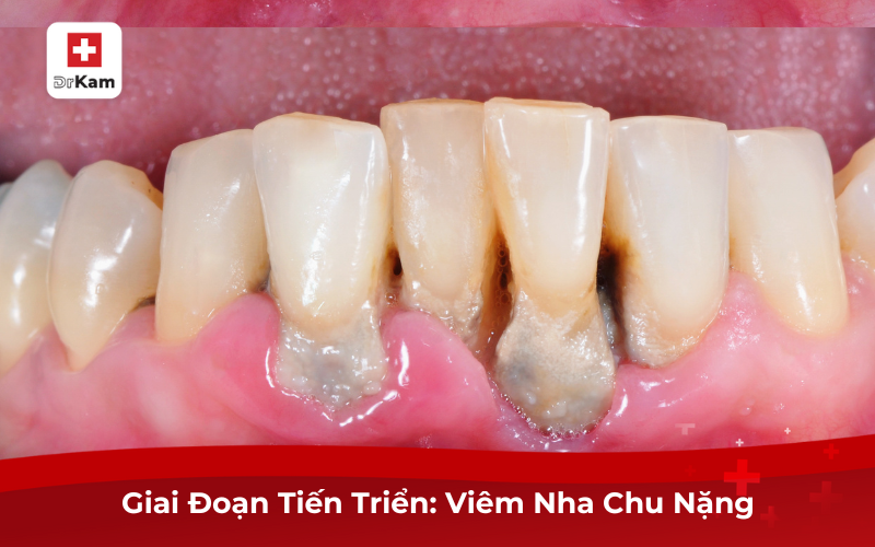 Hình Ảnh Bị Viêm Nha Chu Giúp Sớm Nhận Biết Và Điều Trị 10 Giai Đoạn Tiến Triển: Viêm Nha Chu Nặng