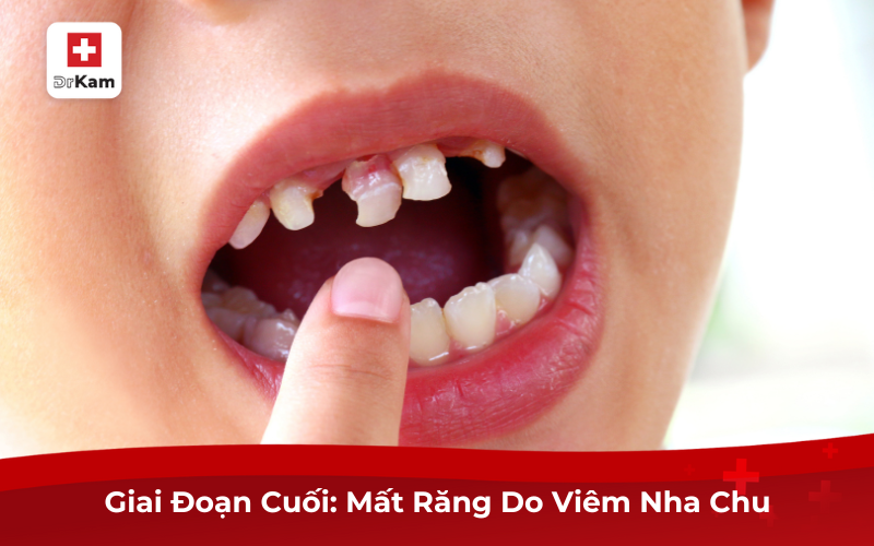 Hình Ảnh Bị Viêm Nha Chu Giúp Sớm Nhận Biết Và Điều Trị 11 Giai Đoạn Cuối: Mất Răng Do Viêm Nha Chu